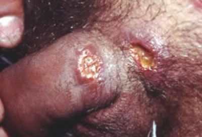 Хламидиоз у женщин и мужчин: симптомы, диагностика