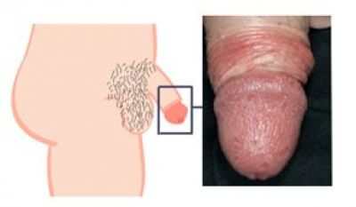 Молочница, симптомы, фото, лечение у мужчин и женщин