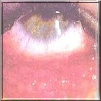 Хламидиоз:симптомы, диагностика и лечение