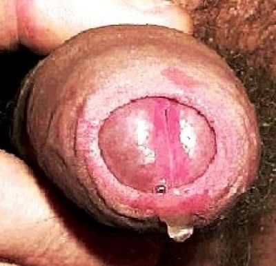 Хламидиоз:симптомы, диагностика и лечение