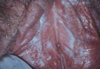 Последствия молочницы