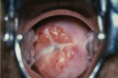 Хламидиоз:симптомы, диагностика и лечение