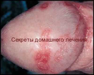 Хламидии трахоматис у женщин и у мужчин - Медицинский Женский Центр в Москве