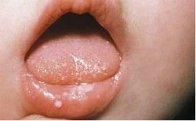 Молочница у женщин: грамотное лечение, восстановление иммунной системы