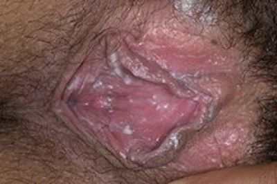 Молочница у женщин: грамотное лечение, восстановление иммунной системы