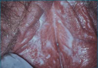 Молочница у женщин: симптомы, лечение молочницы :: Здоровье :: JustLady