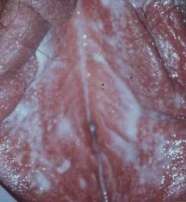 Молочница у женщин: симптомы, лечение молочницы :: Здоровье :: JustLady