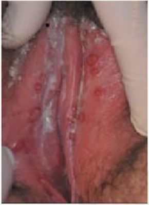 Молочница у женщин: симптомы, лечение молочницы :: Здоровье :: JustLady