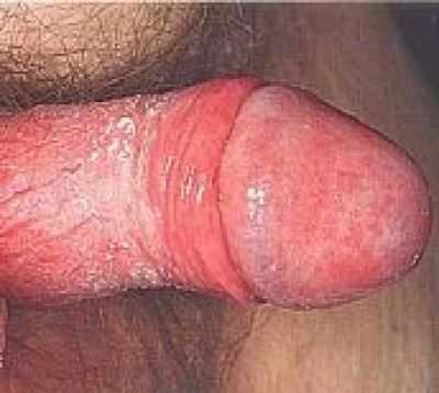 Молочница у женщин: симптомы, лечение молочницы :: Здоровье :: JustLady