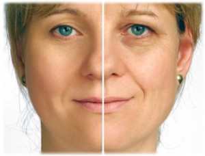 Как избавиться от глубоких морщин?