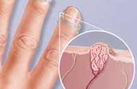 Как избавиться от бородавок?