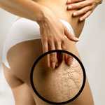 Избавляемся от растяжек!!!