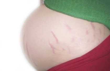 Растяжки во время беременности