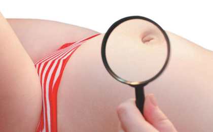 Растяжки во время беременности