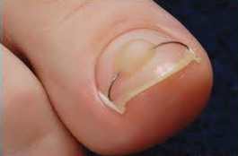 Вросший ноготь на ноге - лечение