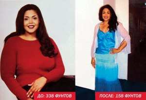 Дебаты по поводу уменьшения желудка