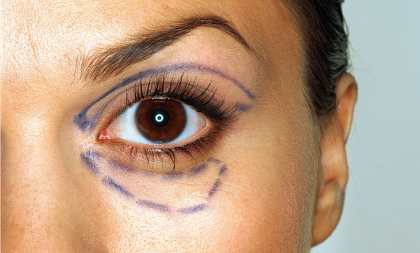 Коррекция век