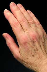 Возрастные пигментные пятна