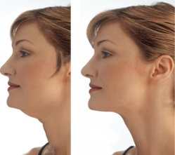 Второй подбородок. Как от него избавиться?
