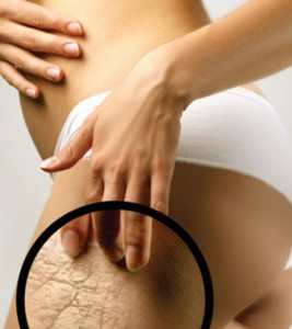 Избавиться от растяжек? Это возможно?